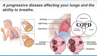 COPD diagram