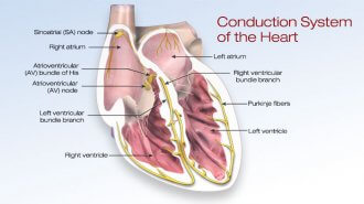 atrial fibrillation