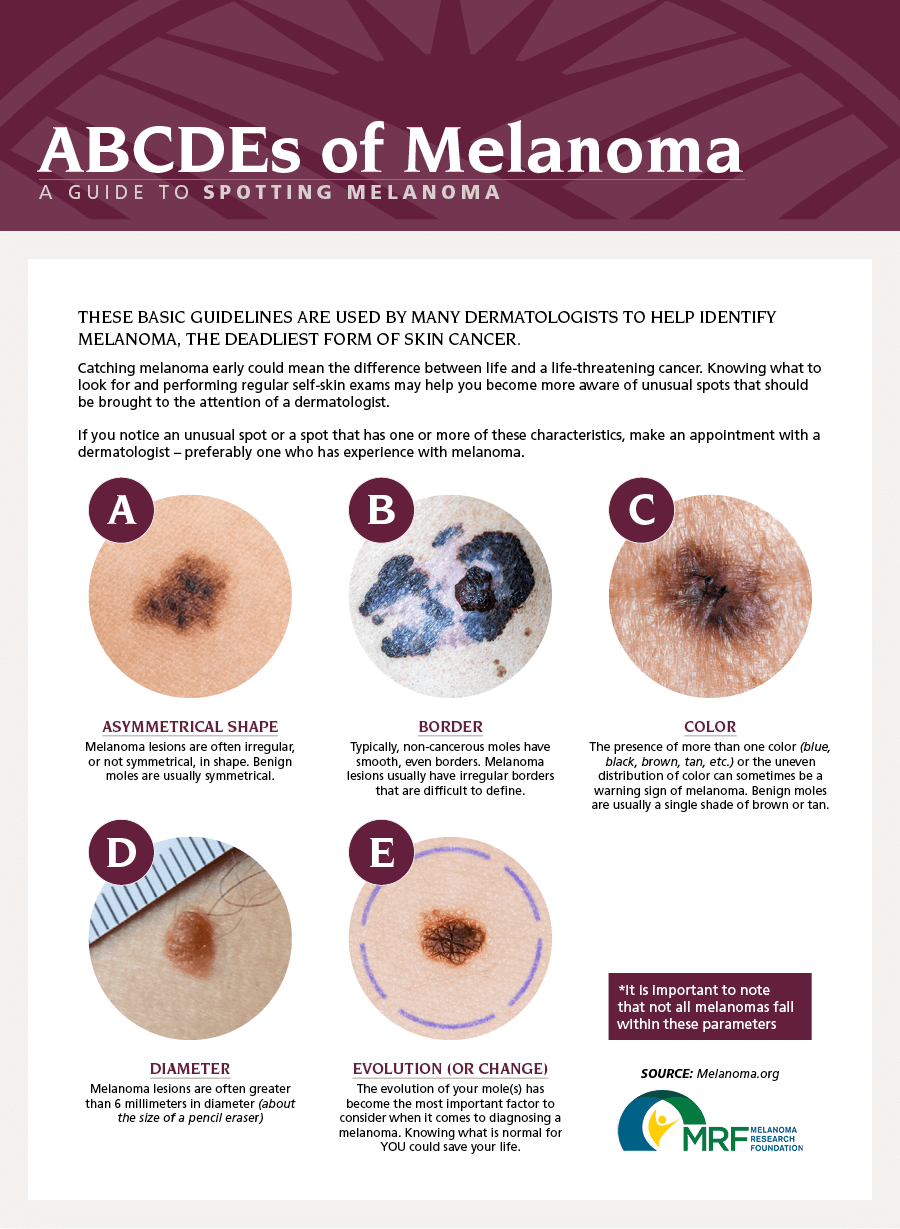 types of melanoma