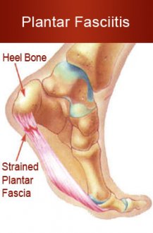 plantar fasciitis diagram